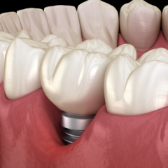 Dental abutment artistic impression