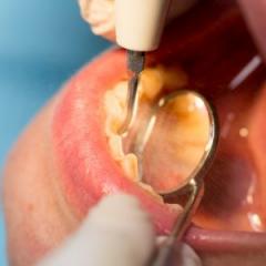 Oral health a challenge for drug users – and for dentists