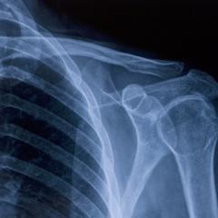 xray of shoulder 